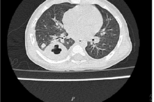 Yên Bái:  Bé gái 11 tháng tuổi nhiễm khuẩn Whitmore