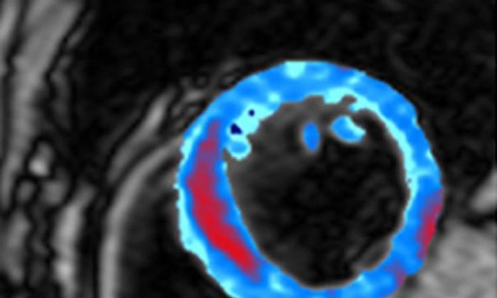 Vùng được tô màu trên ảnh chụp MRI này cho thấy mặt cắt của cơ tim, với vùng chảy máu được tô màu đỏ. AI và QIS có tiềm năng cách mạng hóa lĩnh vực chăm sóc sức khỏe và một loạt các công nghệ khác. (Được phép của Đại học Hoàng gia Luân Đôn)