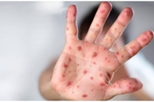 TP. HCM báo động bệnh tay chân miệng: Một tuần cuối tháng 9 có 640 ca