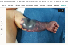 Em bé ở Tuyên Quang chào đời với cánh tay sưng phù, tím đen