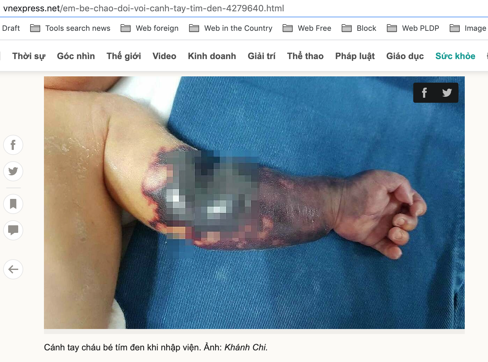 Em bé ở Tuyên Quang chào đời với cánh tay sưng phù, tím đen