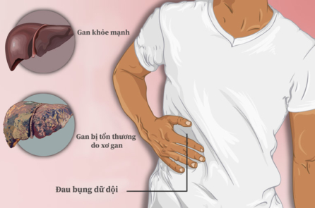 Lá gan của bạn đang kêu cứu trong đại dịch! 4 cách bảo vệ gan