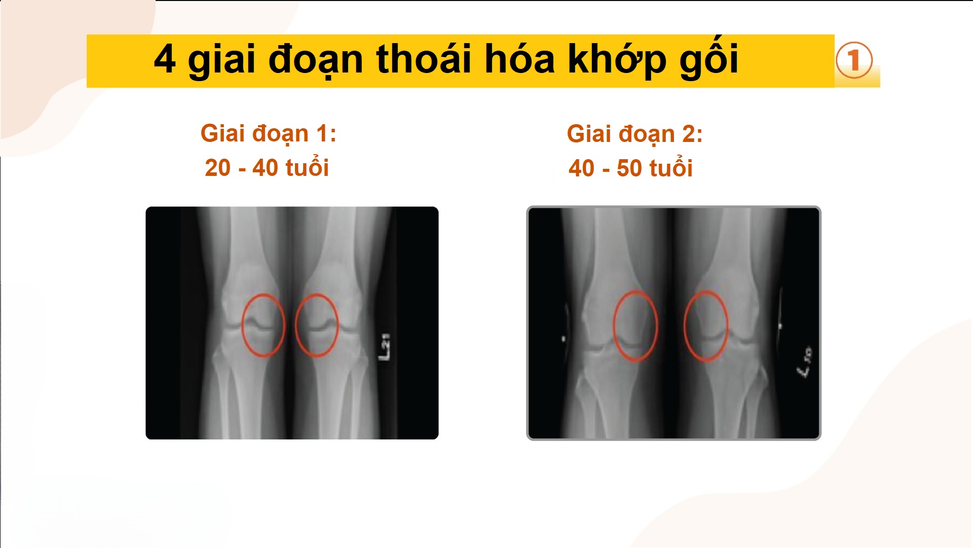 bài tập thoái hóa khớp gối