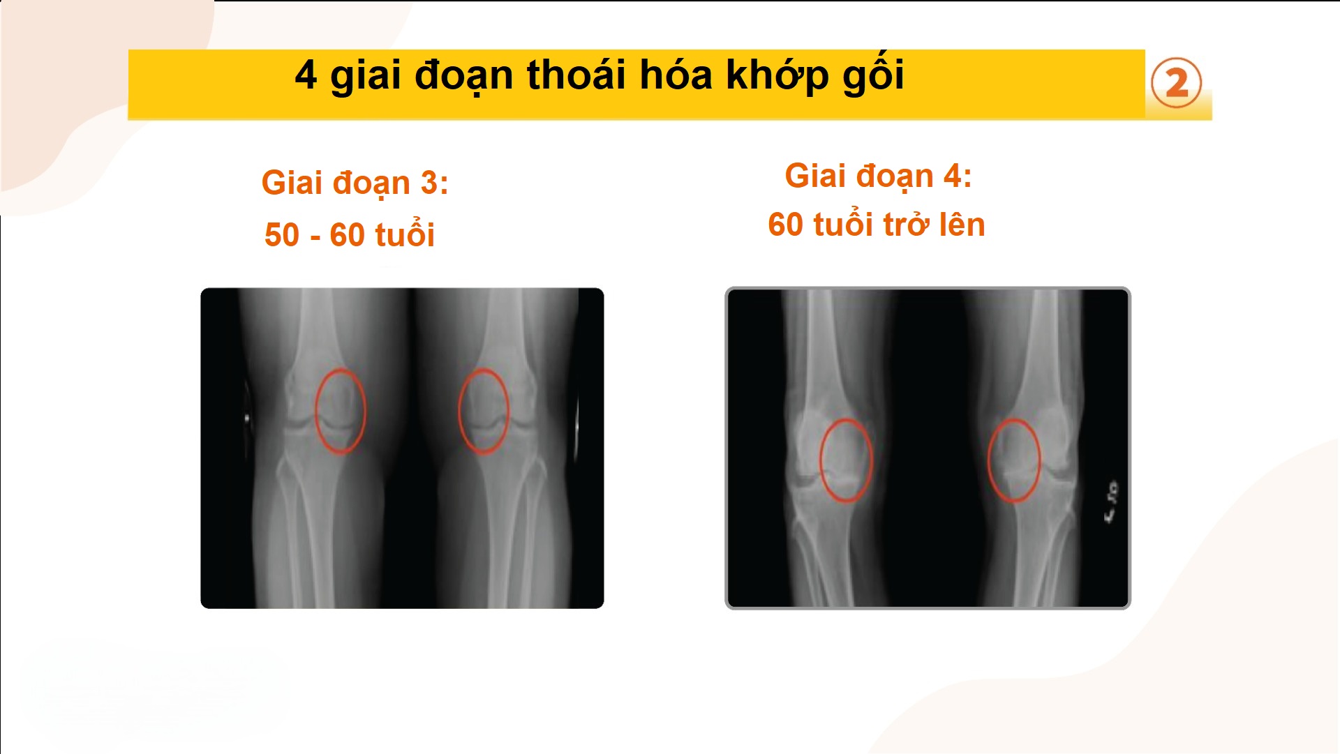 bài tập thoái hóa khớp gối