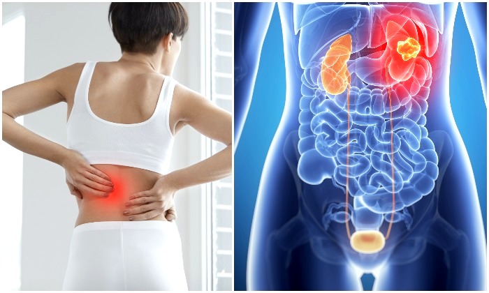 Khi nào đau thắt lưng liên quan đến bệnh thận?