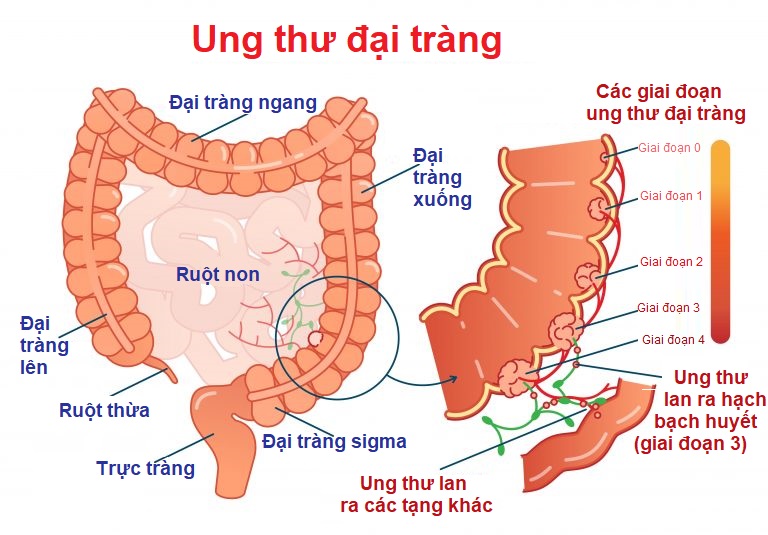 Ăn chay cũng có thể bị ung thư đại tràng? 6 lời khuyên giúp bạn ăn chay lành mạnh