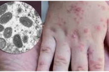 Tin Việt Nam ngày 2/8: Bộ Y tế đưa ra 3 tình huống bệnh đậu mùa khỉ; nguyên nhân giá xăng, dầu giảm ‘nhỏ giọt’ so với thế giới