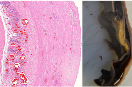 ‘Bằng chứng không thể chối cãi’ rằng vaccine mRNA gây ra tổn thương mạch máu và nội tạng