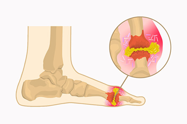 Tác dụng của y học cổ truyền Hàn Quốc trong điều trị bệnh gout đã được xác nhận