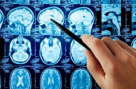 Nghiên cứu: Phương pháp mới giúp ‘bỏ đói’ khối u não 