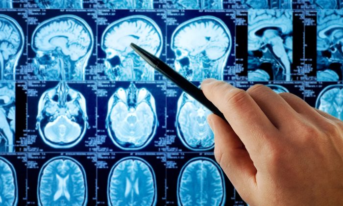 Nghiên cứu: Phương pháp mới giúp ‘bỏ đói’ khối u não 