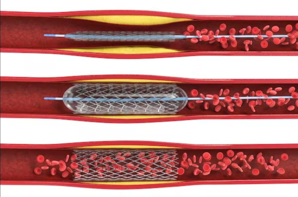 Stents không có lợi trong điều trị suy tim