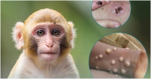 Bệnh đậu mùa khỉ tại Việt Nam