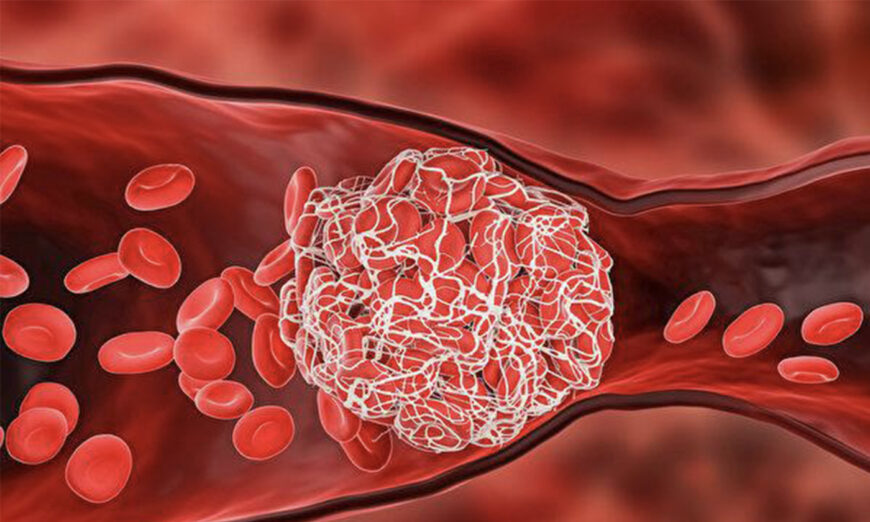 4 thói quen giảm nguy cơ đông máu sau nhiễm COVID-19 hoặc chích ngừa