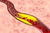 Một nghiên cứu gần đây phát hiện thấy mối quan hệ chặt chẽ giữa cứng khớp và xơ cứng mạch máu. (Ảnh: Fotolia）