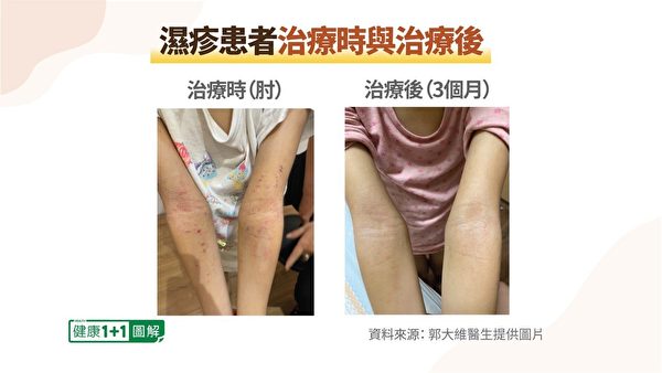 Người bệnh đến điều trị tại phòng khám của bác sĩ Quách Đại Duy, sau khi được trị liệu, làn da ở vùng bị chàm ngứa được cải thiện rõ rệt. (Ảnh: Do chương trình Sức khỏe 1+1 cung cấp)