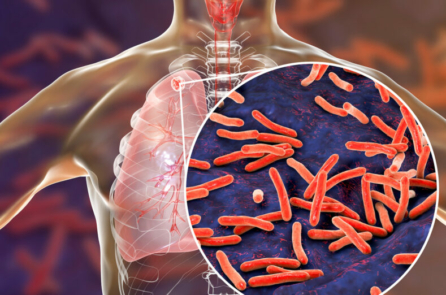 2 chủng vi khuẩn lao tấn công phổi theo các cách hoàn toàn khác nhau
