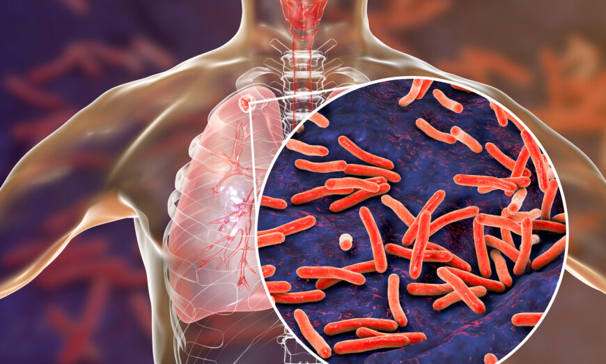 2 chủng vi khuẩn lao tấn công phổi theo các cách hoàn toàn khác nhau
