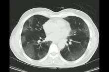 Chụp cắt lớp vi tính (chụp CT) vùng ngực trong một trường hợp được xác nhận nhiễm COVID-19. (Ảnh: Shutterstock)