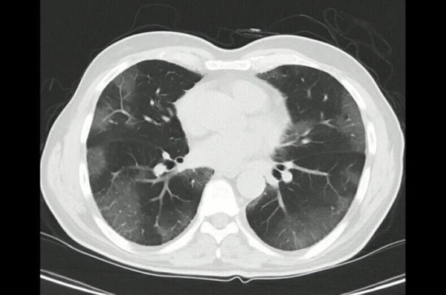 Đáp án cho 6 câu hỏi hàng đầu về bệnh phổi trắng
