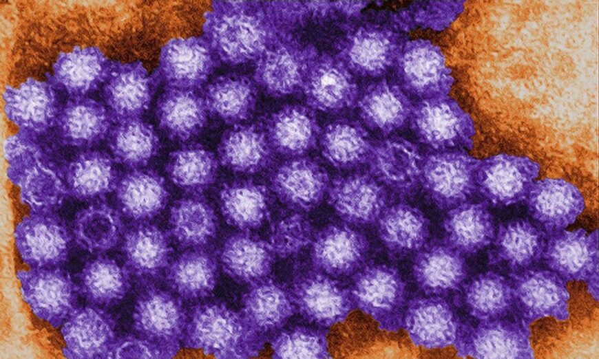 Các ca nhiễm Norovirus đang gia tăng trên khắp Hoa Kỳ: Những điều bạn cần biết