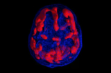 Hình ảnh SPECT chụp  quét não của chứng rối loạn tăng động giảm chú ý type 6 là hình ảnh "Vòng lửa", đặc trưng bởi sự gia tăng bất thường các hoạt động ở nhiều vùng não. (Photo courtesy of Amen Clinic)