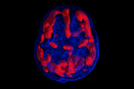 Phương pháp chụp quét não và thay đổi lối sống giúp giải quyết các bệnh tâm thần