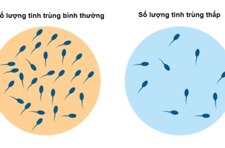 Phân tích gộp: Số lượng tinh trùng toàn cầu giảm với tốc độ nhanh