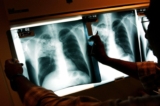 A doctor examines the x-rays of a tuberculosis patient at a TB clinic in Brooklyn, New York, on Nov. 27, 2002. (Spencer Platt/Getty Images)
