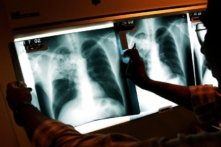 A doctor examines the x-rays of a tuberculosis patient at a TB clinic in Brooklyn, New York, on Nov. 27, 2002. (Spencer Platt/Getty Images)