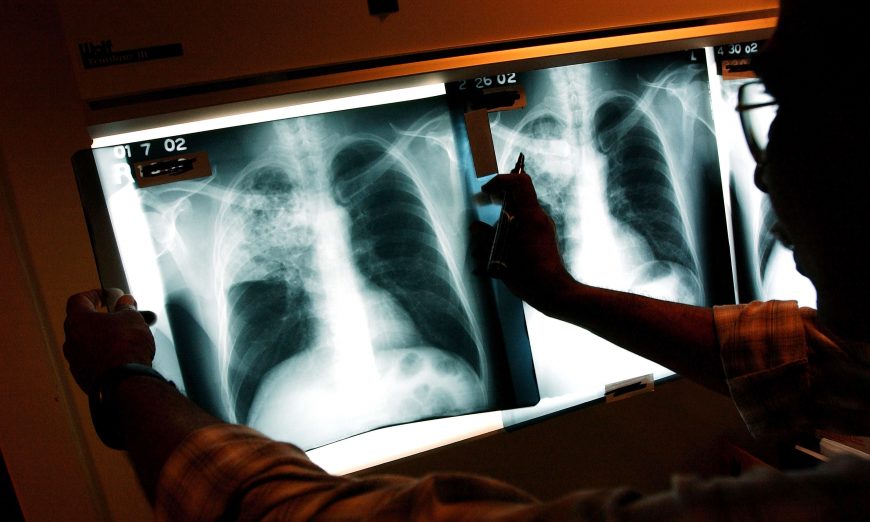 A doctor examines the x-rays of a tuberculosis patient at a TB clinic in Brooklyn, New York, on Nov. 27, 2002. (Spencer Platt/Getty Images)