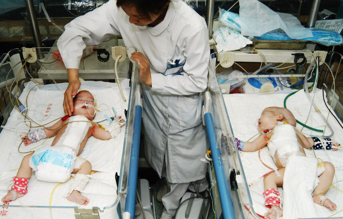 Một y tá kiểm tra một cặp song sinh người Xiêm ở tỉnh Sơn Tây sau ca phẫu thuật mổ tách hai bé vào ngày 01/06/2005, tại bệnh viện Tân Hoa ở Thượng Hải, Trung Quốc. (Ảnh: China Photos/Getty Images)