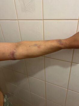 Học viên Pháp Luân Công Nancy Dong bị thương sau khi bị hai người đàn ông thân Bắc Kinh ở Canberra, Úc tấn công vào ngày 04/10/2022. (Ảnh: Đăng dưới sự cho phép của bà Nancy Dong)
