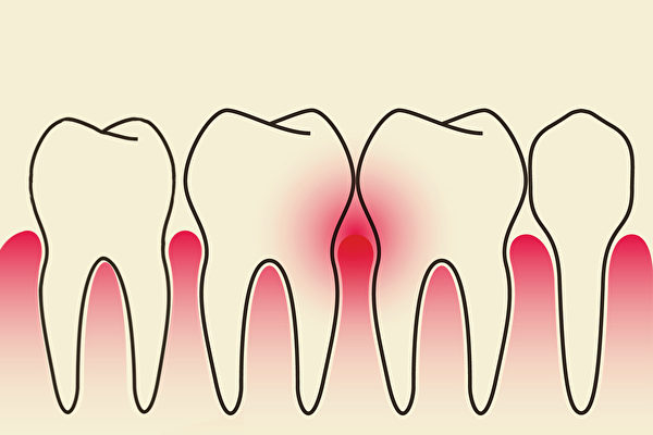 Người xưa và người hiện đại đều mắc bệnh răng miệng, Trung y điều trị bệnh nha chu như thế nào?