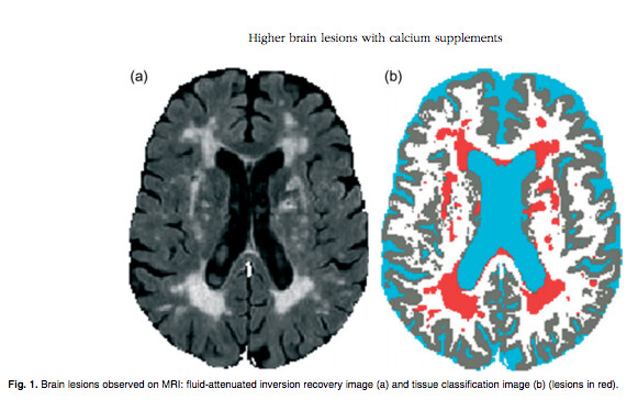 Quét não: MRI, những đốm sáng tăng tín hiệu