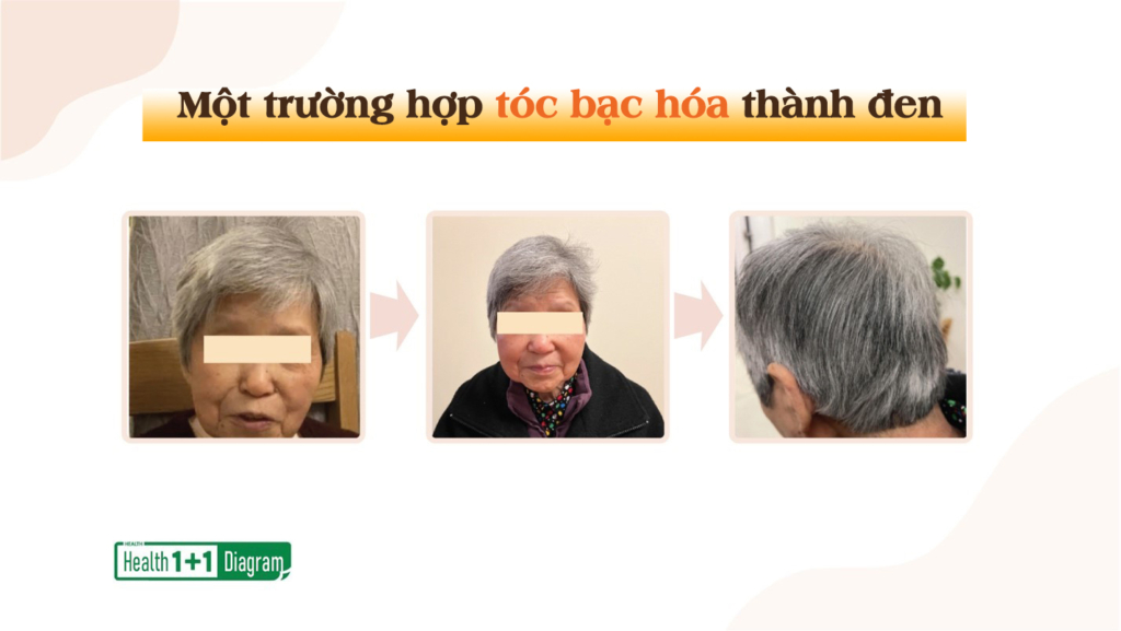 3 nguyên nhân gây ra tóc bạc và 3 cách đảo ngược tình trạng bạc tóc