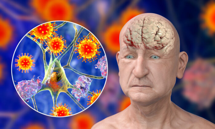 COVID-19 làm tăng tốc độ lão hóa não như thế nào và cách bảo vệ bản thân