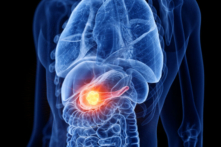 Ung thư tuyến tụy được mệnh danh là “vua ung thư biểu mô” và là căn bệnh gây tử vong cao. (Ảnh: SciePro/Shutterstock)