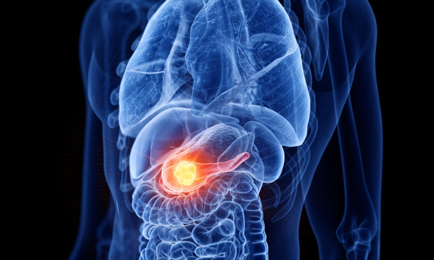 Ung thư tuyến tụy được mệnh danh là “vua ung thư biểu mô” và là căn bệnh gây tử vong cao. (Ảnh: SciePro/Shutterstock)