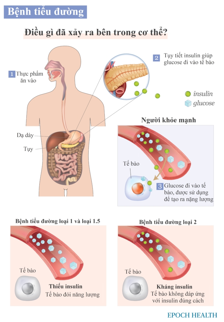 Bệnh tiểu đường: Dấu hiệu sớm, nguyên nhân, điều trị, và giải pháp tự nhiên