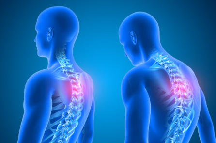 Thói quen ngồi xấu gây gù lưng, 3 bí quyết sửa đơn giản