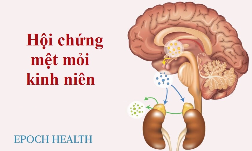 Hướng dẫn cơ bản về hội chứng mệt mỏi kinh niên: Triệu chứng, nguyên nhân, điều trị, và giải pháp tự nhiên