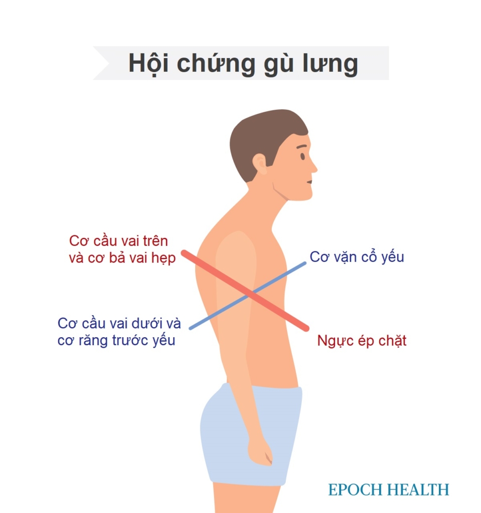 Thói quen ngồi xấu gây gù lưng, 3 bí quyết sửa đơn giản