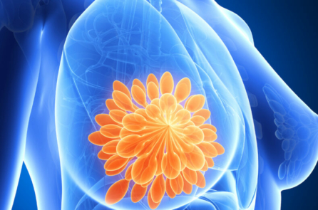 Ung thư vú: 3 nhóm người có nguy cơ cao và 6 huyệt vị dự phòng