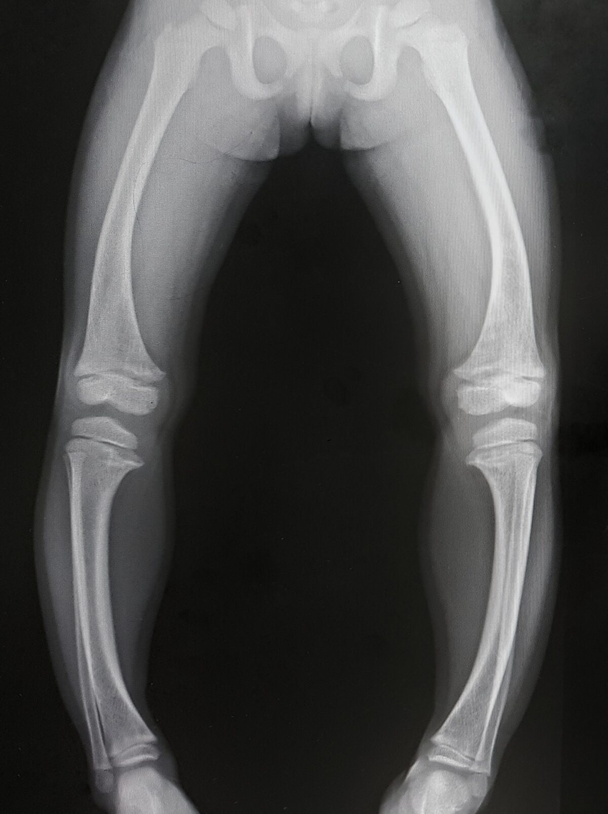 Ảnh chụp X-quang chân vòng kiềng, biểu hiện của bệnh còi xương. (Shutterstock)