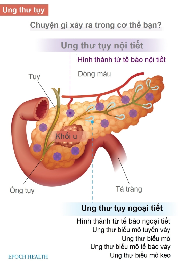 Hướng dẫn cơ bản về ung thư tụy: Triệu chứng, nguyên nhân, phương pháp điều trị và phương pháp tự nhiên