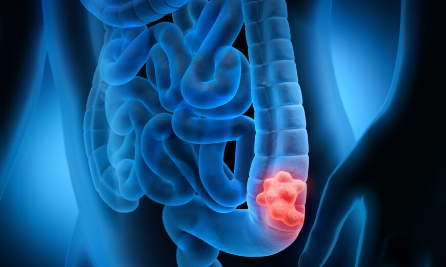 Hình minh họa 3D một cơ thể có polyp đường ruột. (Ảnh: peterschreiber.media/Shutterstock)