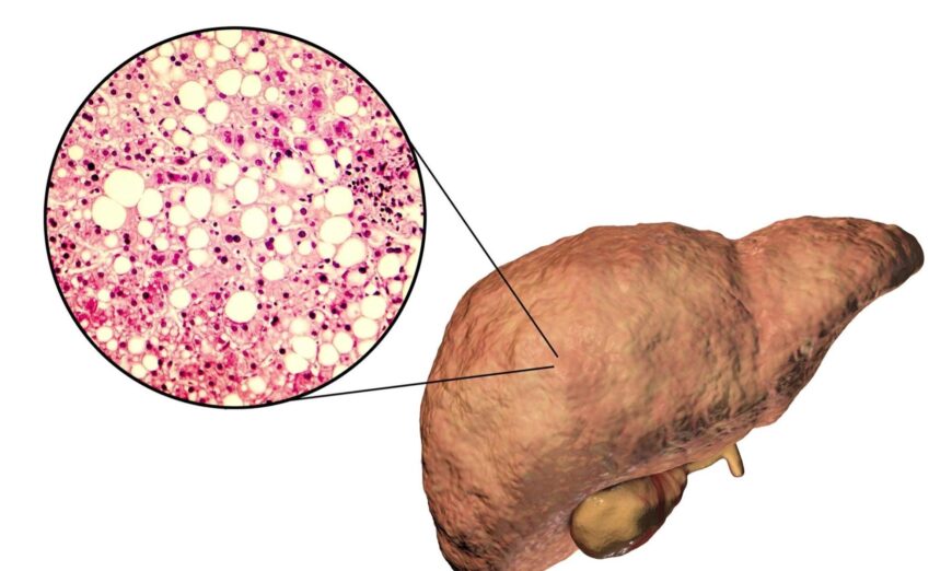 Gan nhiễm mỡ làm tăng nguy cơ ung thư gan–Mẹo phát hiện và phòng ngừa sớm