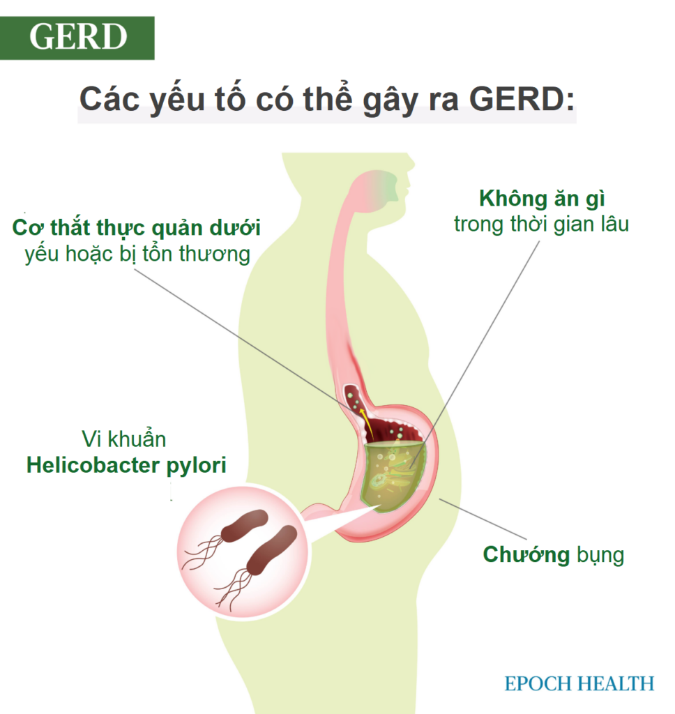 Trào ngược acid và GERD: Triệu chứng, nguyên nhân, điều trị, và các giải pháp tự nhiên