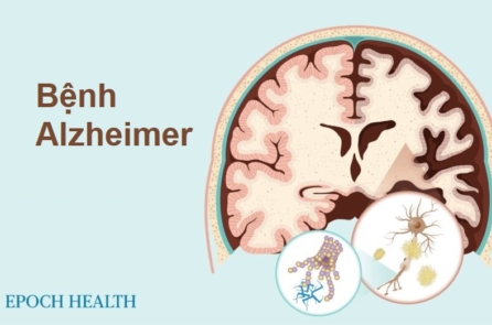 Hướng dẫn cơ bản về bệnh Alzheimer: Triệu chứng, nguyên nhân, điều trị, và giải pháp tự nhiên